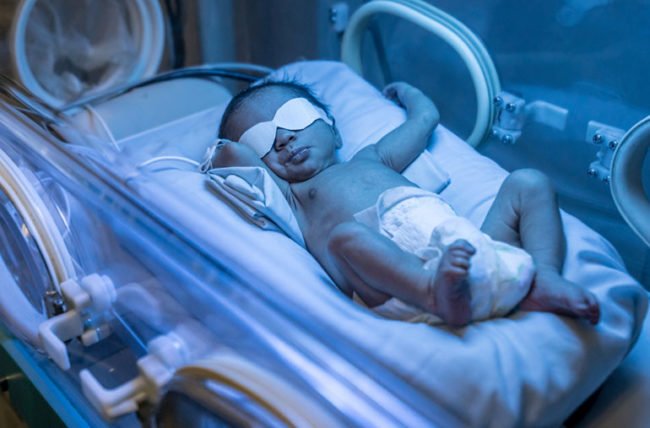 Jaundice in Preterm Babies: Caring for Jaundiced Preterm Babies at Home